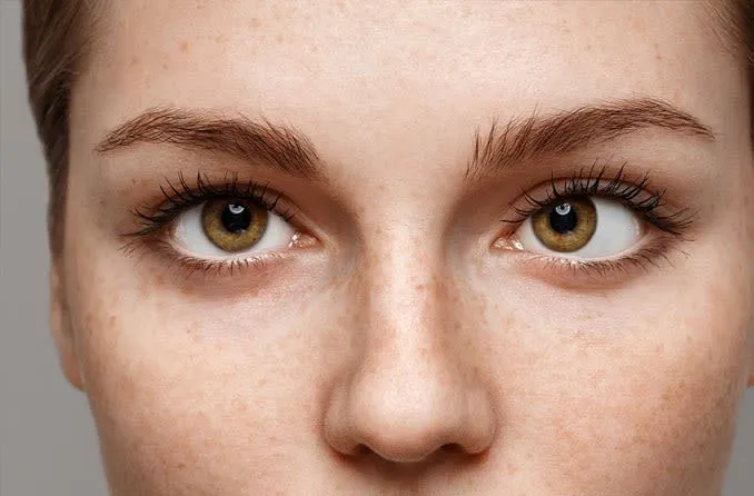 Strabismus
